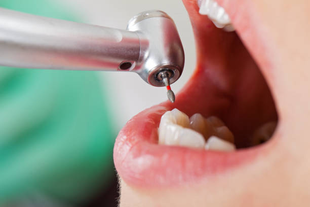 Best Emergency Tooth Extraction in Lakewood Park, TN